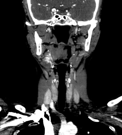 File:Carotid body tumor (Radiopaedia 39845-42300 C 5).jpg
