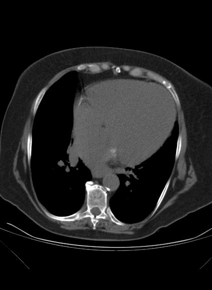 File:Caseous mitral annular calcification (Radiopaedia 61219-69122 Axial non-contrast 11).jpg