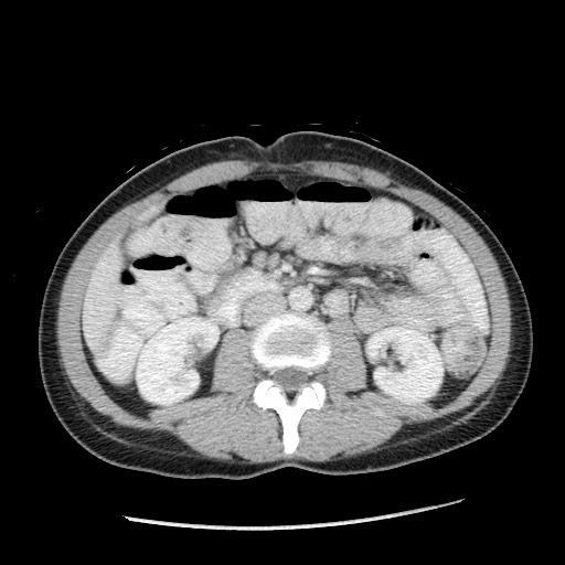 Castleman disease with fibrous pseudotumor in the abdomen (Radiopaedia 77296-89373 A 60).jpg