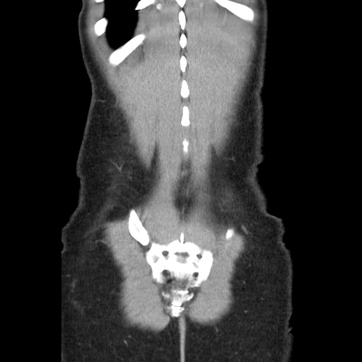 Castleman disease with fibrous pseudotumor in the abdomen (Radiopaedia 77296-89373 B 85).jpg