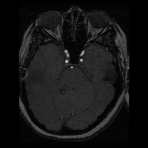 Cavernoma, DVA and right ICA aneurysm (Radiopaedia 33890-35072 E 64).png