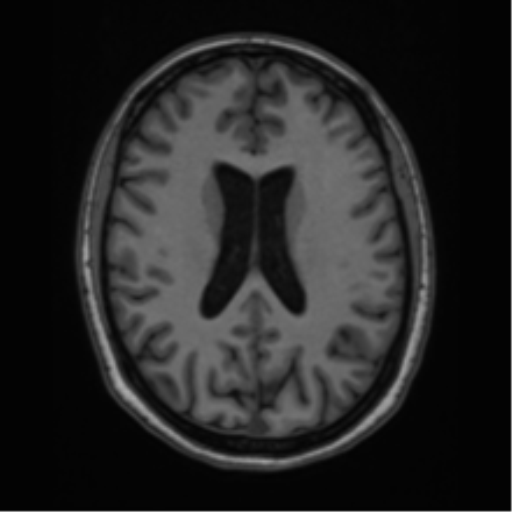 Cavernoma with bleed - midbrain (Radiopaedia 54546-60774 Axial T1 30).png