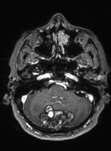 Cavernous hemangioma of the cerebellar falx (Radiopaedia 73025-83724 Axial T1 C+ 263).jpg