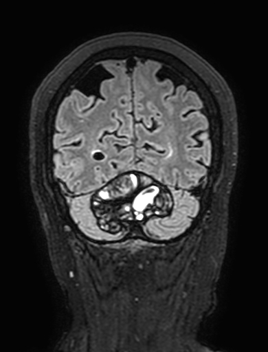 Cavernous hemangioma of the cerebellar falx (Radiopaedia 73025-83724 Coronal FLAIR 293).jpg