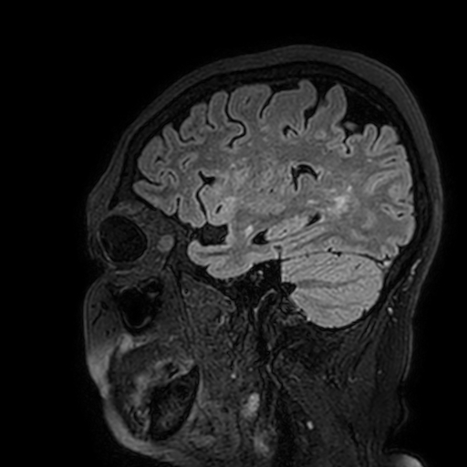 Cavernous hemangioma of the cerebellar falx (Radiopaedia 73025-83724 Sagittal FLAIR 165).jpg