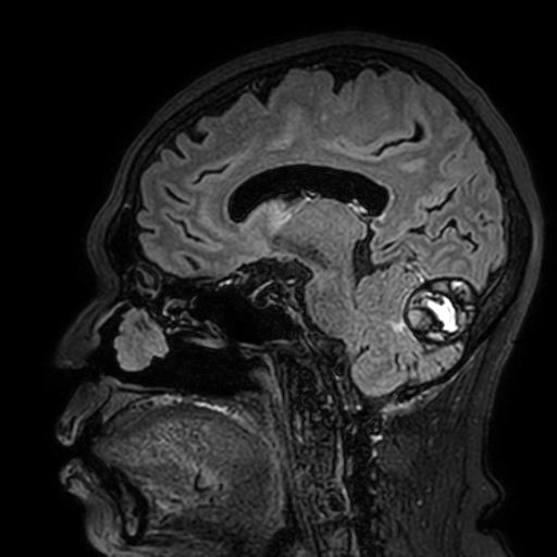 Cavernous hemangioma of the cerebellar falx (Radiopaedia 73025-83724 Sagittal FLAIR 90).jpg