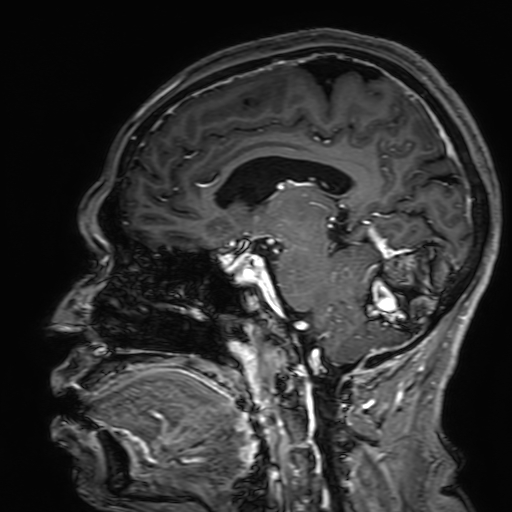 File:Cavernous hemangioma of the cerebellar falx (Radiopaedia 73025-83724 Sagittal T1 C+ 118).jpg