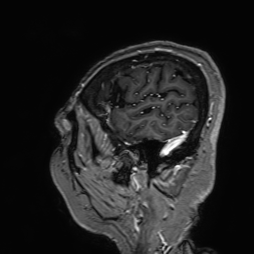 Cavernous hemangioma of the cerebellar falx (Radiopaedia 73025-83724 Sagittal T1 C+ 28).jpg