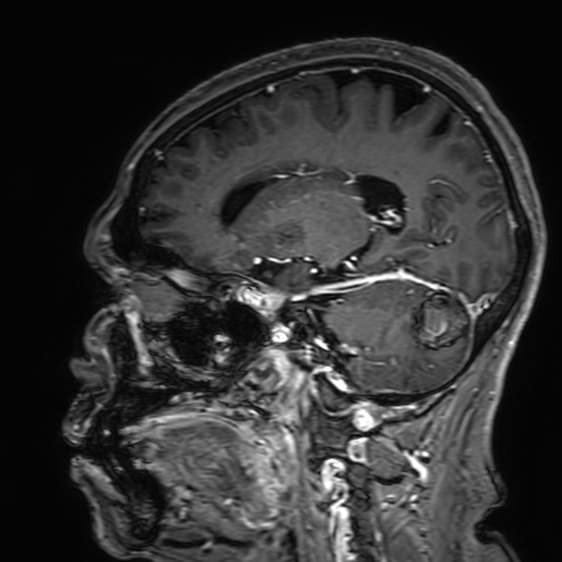 Cavernous hemangioma of the cerebellar falx (Radiopaedia 73025-83724 Sagittal T1 C+ 81).jpg