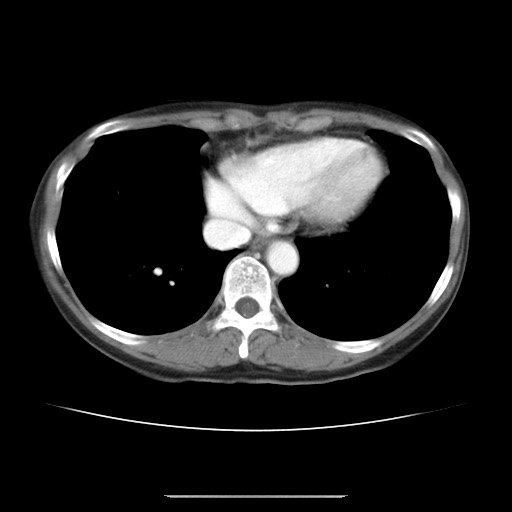 Cavernous hepatic hemangioma (Radiopaedia 75441-86667 B 4).jpg