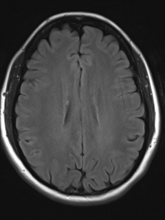 File:Cavernous malformation (cavernous angioma or cavernoma) (Radiopaedia 36675-38237 Axial T2 FLAIR 14).png
