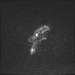 Cavernous sinus meningioma (Radiopaedia 63682-72367 Sagittal T1 C+ 172).jpg