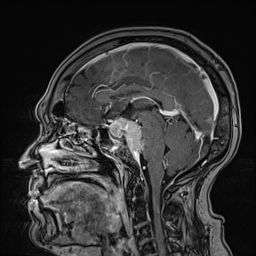 Cavernous sinus meningioma (Radiopaedia 63682-72367 Sagittal T1 C+ 93).jpg