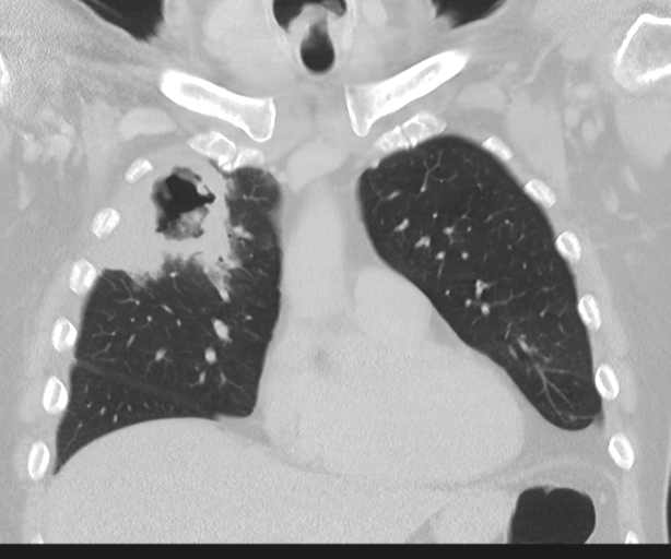 Cavitating pneumonia (Radiopaedia 45998-50329 Coronal lung window 17).png