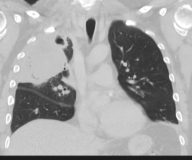 Cavitating pneumonia (Radiopaedia 45998-50329 Coronal lung window 23).png