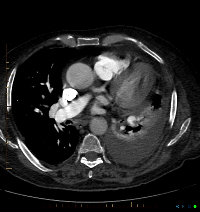 Cavitating pulmonary infarction (Radiopaedia 54634-60849 Axial C+ CTPA 43).jpg