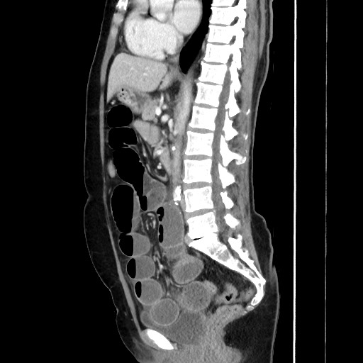Cecal adenocarcinoma (Radiopaedia 75909-87331 C 38).jpg