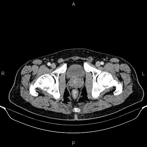 File:Cecal adenocarcinoma (Radiopaedia 85324-100916 B 98).jpg