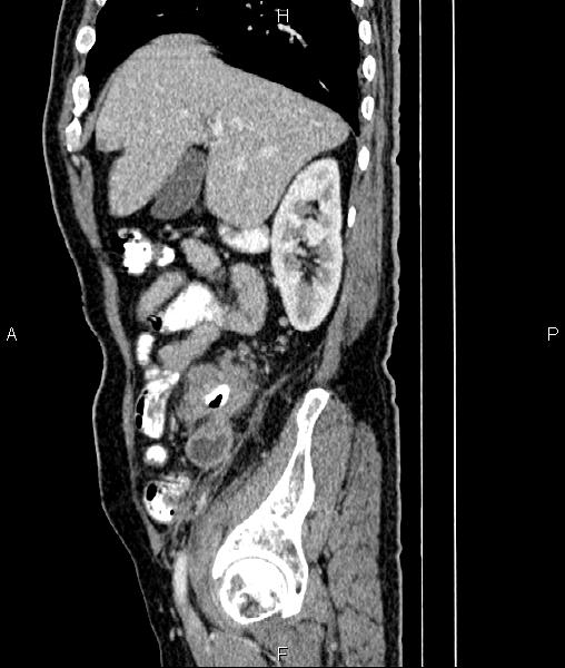 Cecal cancer with appendiceal mucocele (Radiopaedia 91080-108651 E 26).jpg
