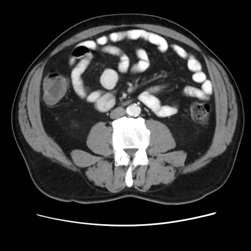 Cecal mass causing appendicitis (Radiopaedia 59207-66531 A 48).jpg