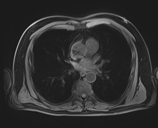 Cecal mass causing appendicitis (Radiopaedia 59207-66532 Axial T1 2).jpg