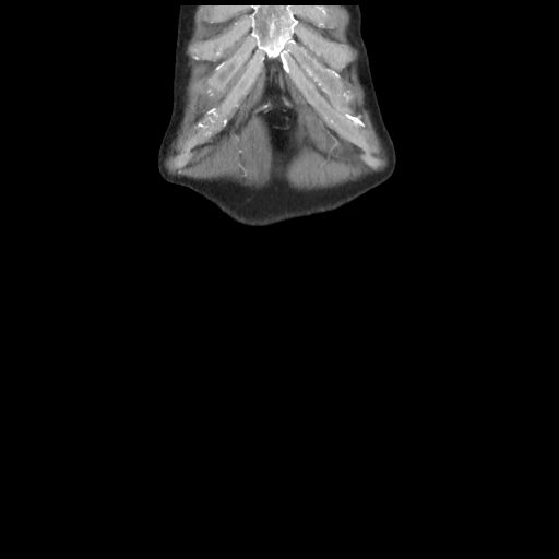 Cecal volvulus (Radiopaedia 89212-106088 D 1).jpg
