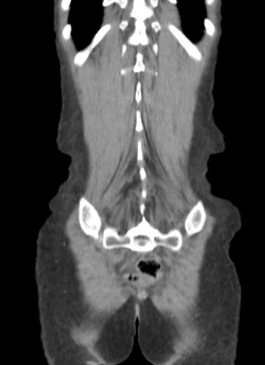 Cecal volvulus with pneumatosis coli (Radiopaedia 68572-78178 B 6).jpg