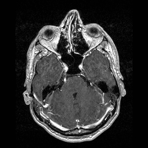 File:Central-variant posterior reversible encephalopathy syndrome (PRES) (Radiopaedia 43880-47358 Axial T1 C+ 40).jpg
