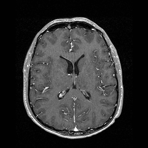 Central-variant posterior reversible encephalopathy syndrome (PRES) (Radiopaedia 43880-47358 Axial T1 C+ 94).jpg