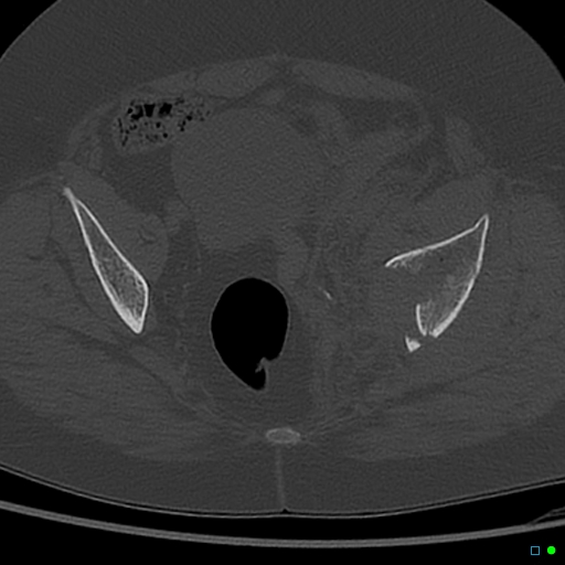 File:Central fracture-dislocation of the acetabulum (Radiopaedia 36578-38150 Axial bone window 43).jpg