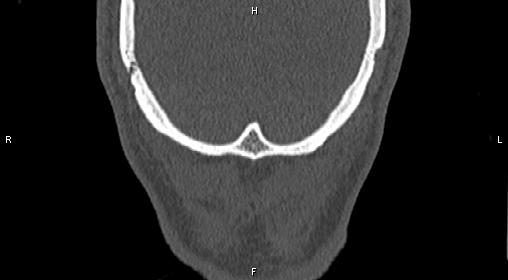 Central giant cell granuloma (Radiopaedia 83346-97761 Coronal bone window 52).jpg