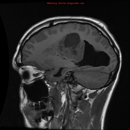 File:Central neurocytoma (Radiopaedia 13188-13206 Sagittal T1 4).jpg