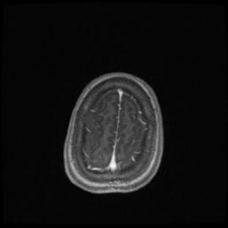 Central neurocytoma (Radiopaedia 30220-30842 Axial T1 C+ 135).jpg