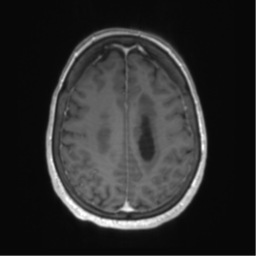 Central neurocytoma (Radiopaedia 65317-74345 Axial T1 C+ 44).png