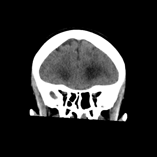 File:Central neurocytoma (Radiopaedia 65317-74346 Coronal non-contrast 18).png