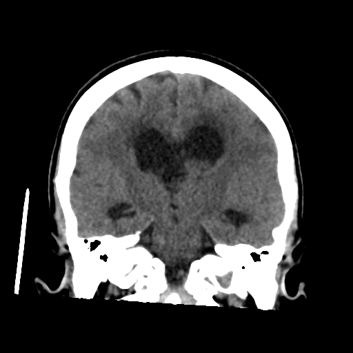 Central neurocytoma (Radiopaedia 65317-74346 Coronal non-contrast 32).png