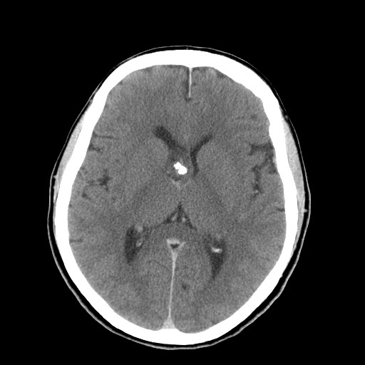 Central neurocytoma (Radiopaedia 68725-78432 Axial C+ 41).jpg