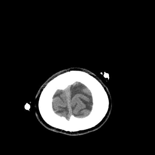 File:Central neurocytoma (Radiopaedia 68725-78432 Axial non-contrast 52).jpg