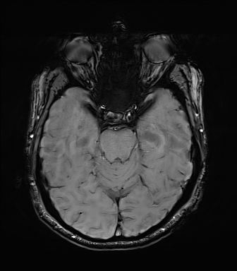 Central neurocytoma (Radiopaedia 71068-81303 Axial SWI 19).jpg