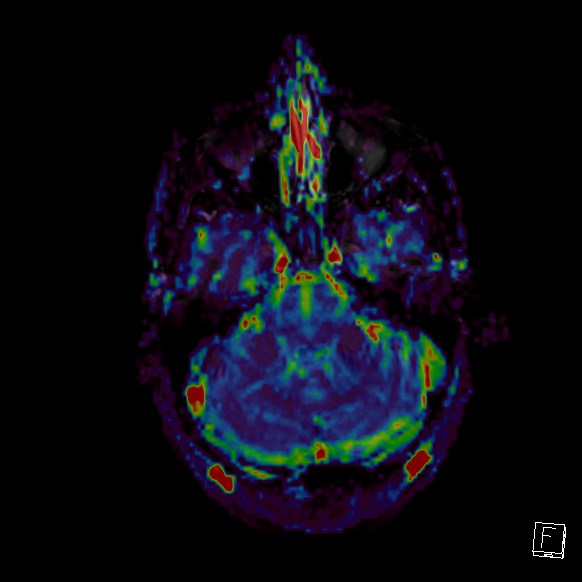 Central neurocytoma (Radiopaedia 84497-99872 Axial Perfusion 244).jpg