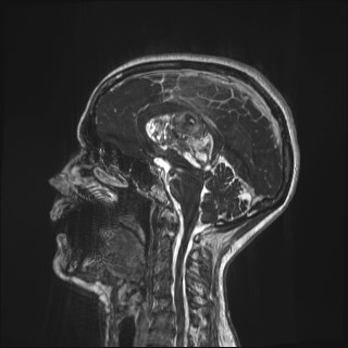 Central neurocytoma (Radiopaedia 84497-99872 Sagittal CISS 39).jpg