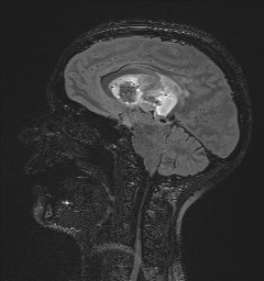 Central neurocytoma (Radiopaedia 84497-99872 Sagittal Flair + Gd 73).jpg
