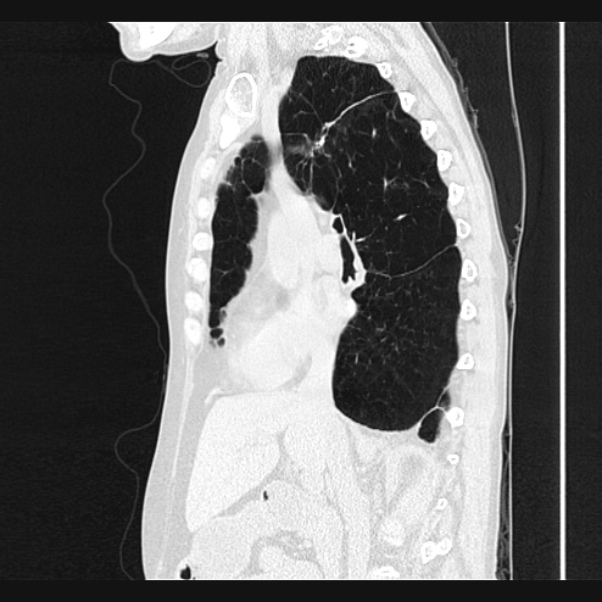 Centrilobular pulmonary emphysema (Radiopaedia 24495-24789 Sagittal lung window 36).jpg