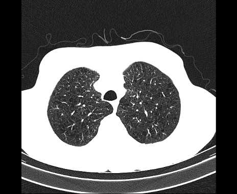 Centrilobular pulmonary emphysema (Radiopaedia 62468-70718 Axial lung window 15).jpg