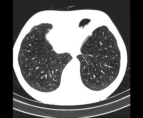Centrilobular pulmonary emphysema (Radiopaedia 62468-70718 Axial lung window 63).jpg