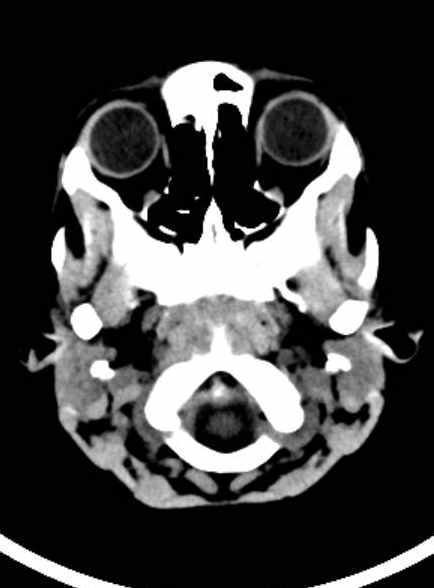 Cerebellar abscess (Radiopaedia 73727-84527 Axial non-contrast 20).jpg