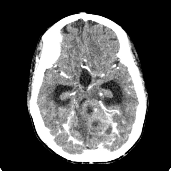 Cerebellar abscess secondary to mastoiditis (Radiopaedia 26284-26412 Axial C+ delayed 57).jpg