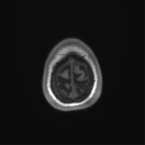 File:Cerebellar agenesis with hypoplastic pons (pontocerebellar hypoplasia) (Radiopaedia 57224-64138 Axial T1 72).png