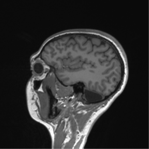 Cerebellar agenesis with hypoplastic pons (pontocerebellar hypoplasia) (Radiopaedia 57224-64138 Sagittal T1 21).png