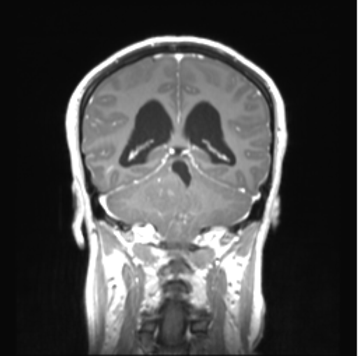Cerebellar ependymoma complicated by post-operative subdural hematoma (Radiopaedia 83322-97736 Coronal T1 C+ 37).png